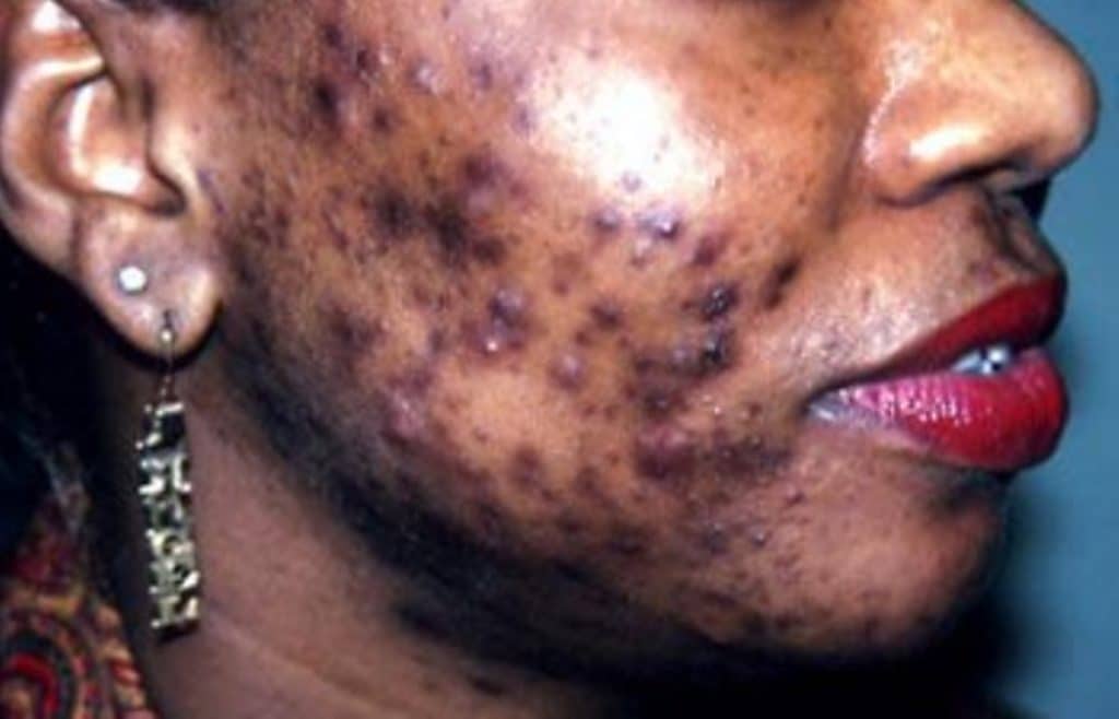 dépigmentation